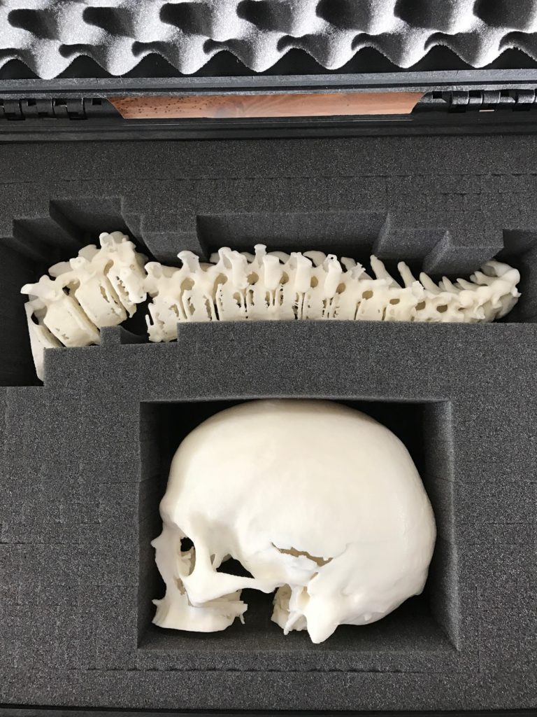 Skull Spine Injury 3D Print 